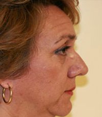 Rhinoplasty Case 5 - before - front