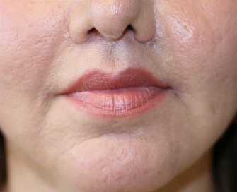 Lip Lift San Diego 28 - after - front