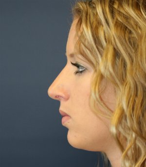 Nose Rhinoplasty 43 - after - front