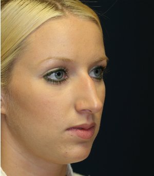 Nose Rhinoplasty 43 - before - oblique
