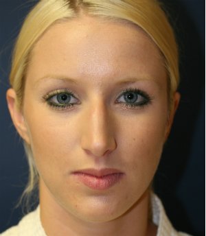 Nose Rhinoplasty 43 - before - side