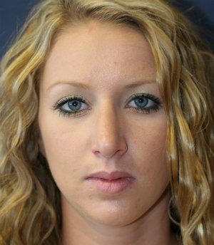 Nose Rhinoplasty 43 - after - side