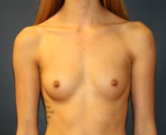 Breast Augmentation San Diego 94 - before - front