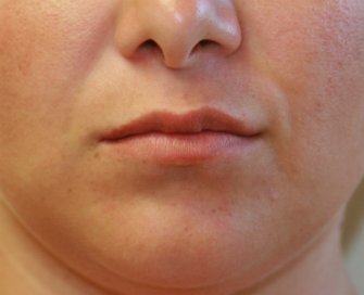 Lip Augmentation San Diego 29 - before - front