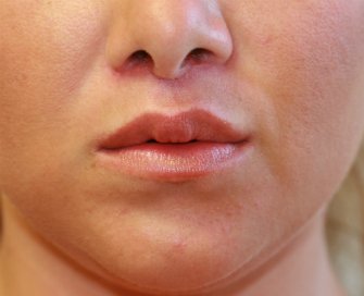 Lip Augmentation San Diego 29 - after - front