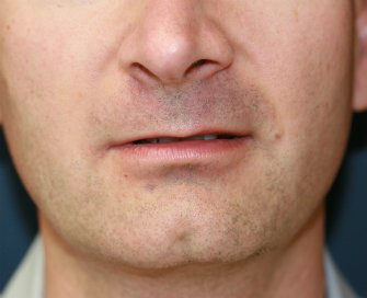 Lip Augmentation San Diego 30 - before - front
