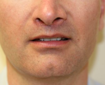Lip Augmentation San Diego 30 - after - front