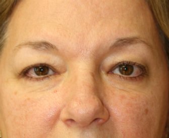 Eyelid Surgery San Diego Case 70 - before - front