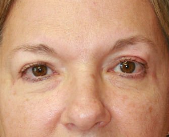 Eyelid Surgery San Diego Case 70 - after - front