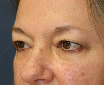 Eyelid Surgery San Diego Case 70 - before - oblique