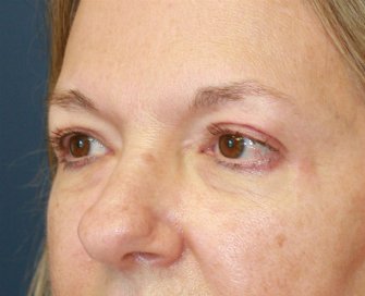 Eyelid Surgery San Diego Case 70 - after - oblique