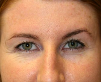 Eyelid Surgery San Diego Case 71 - before - front