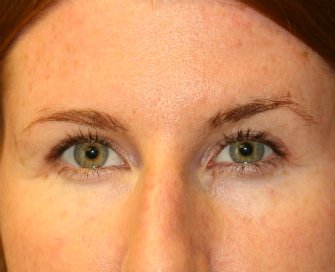 Eyelid Surgery San Diego Case 71 - after - front