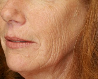 Laser Skin Renewal San Diego 8 - before - front