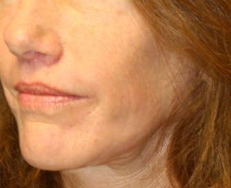 Laser Skin Renewal San Diego 8 - after - front