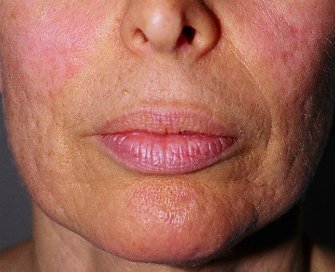 Laser Skin Renewal San Diego 9 - before - front