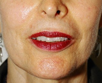 Laser Skin Renewal San Diego 9 - after - front