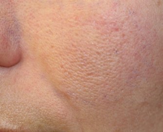 Laser Skin Renewal San Diego 10 - before - front