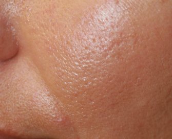 Laser Skin Renewal San Diego 10 - after - front