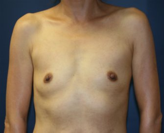 Breast Implants San Diego 96 - before - front