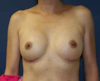 Breast Implants San Diego 96 - after - front
