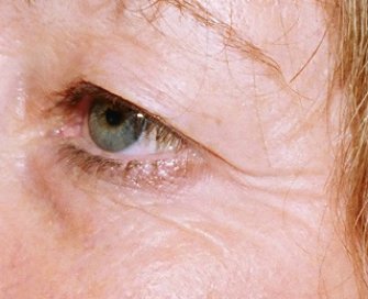 Laser Skin Renewal San Diego 11 - before - front