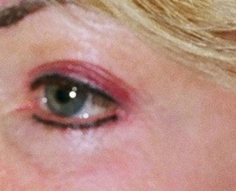 Laser Skin Renewal San Diego 11 - after - front