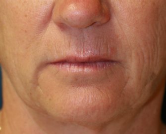 Laser Skin Around Lips - before - front