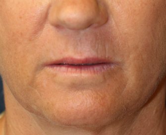 Laser Skin Around Lips - after - front