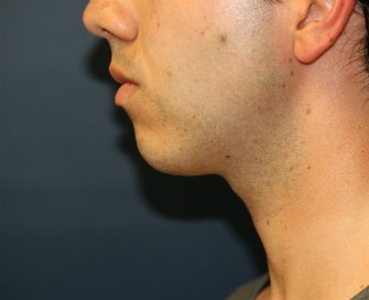 Chin Implant San Diego - before - front