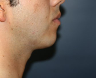 Chin Implant San Diego - before - oblique