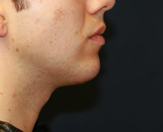 Chin Implant San Diego - after - oblique