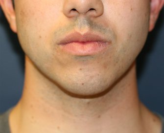 Chin Implant San Diego - before - side