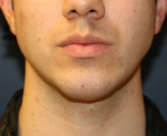 Chin Implant San Diego - after - side