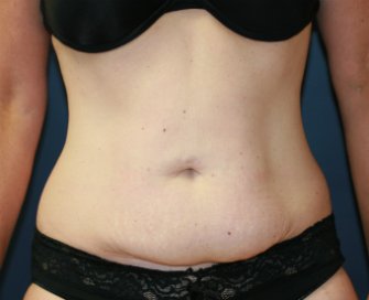Tummy Tuck San Diego 53 - before - front