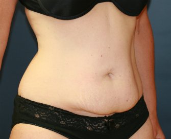 Tummy Tuck San Diego 53 - before - oblique