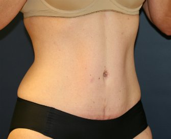 Tummy Tuck San Diego 53 - after - oblique