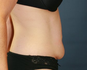 Tummy Tuck San Diego 53 - before - side