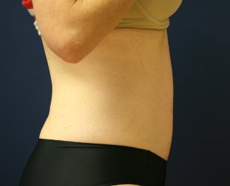 Tummy Tuck San Diego 53 - after - side