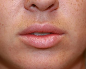 Lip Augmentation with Permalip - before - front