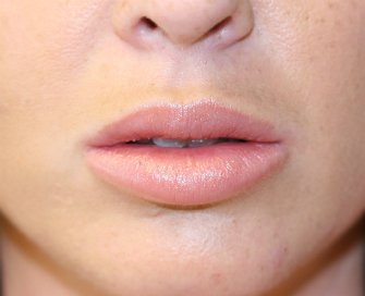 Lip Augmentation with Permalip - after - front