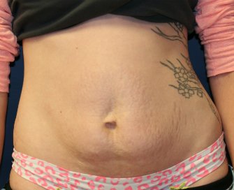 Tummy Tuck San Diego 54 - before - front