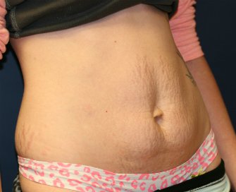 Tummy Tuck San Diego 54 - before - oblique