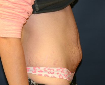 Tummy Tuck San Diego 54 - before - side