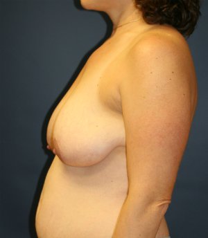 Breast Lift San Diego 24 - before - side