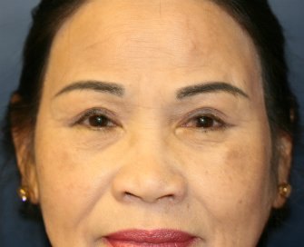 Eyelid Lift San Diego 73 - after - front