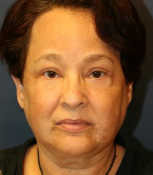 Eyelid Rejuvenation San Diego 74 - after - front