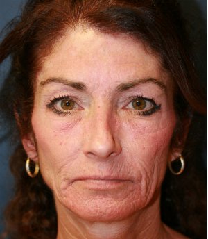 Laser Facial Skin Rejuvenation - before - front