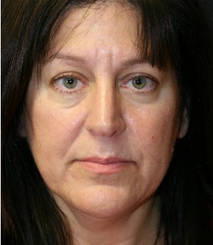 Face and Neck Lift San Diego - before - front