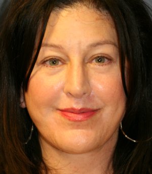 Face and Neck Lift San Diego - after - front